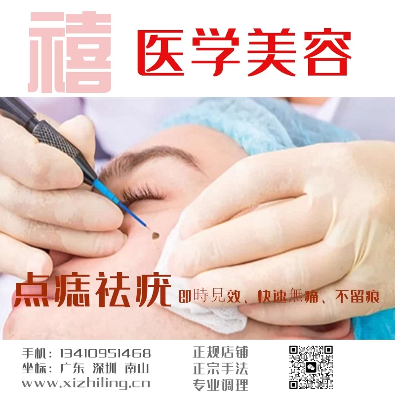 Xizhiling TCM Mole Removal and Wart Removal: Instant Results, Fast and Painless, No Scars
