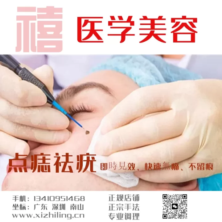 Xizhiling TCM Mole Removal and Wart Removal: Instant Results, Fast and Painless, No Scars